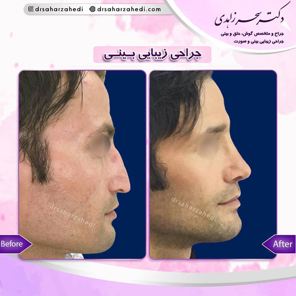 جراحی بینی