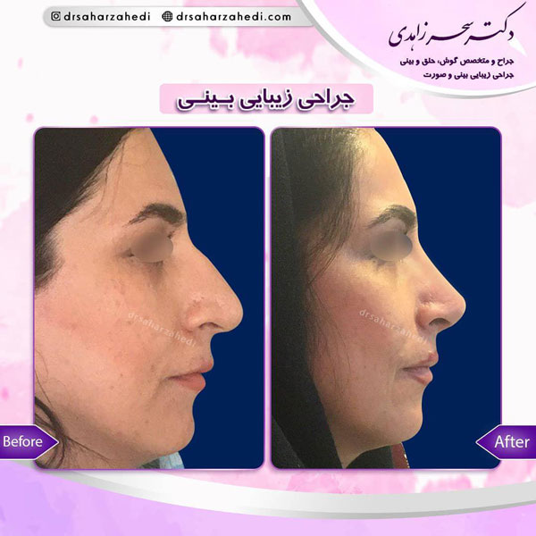 جراحی بینی استخوانی