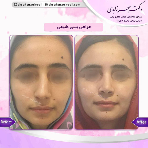 جراحی بینی طبیعی