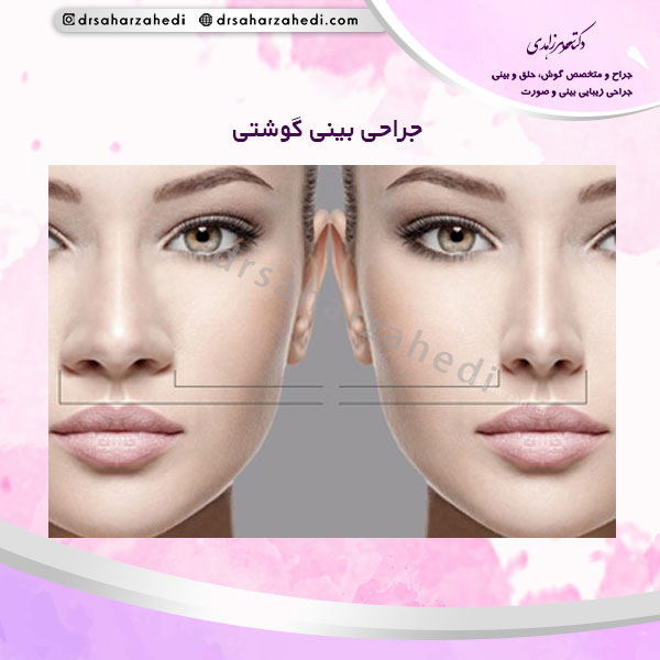 جراحی بینی گوشتی