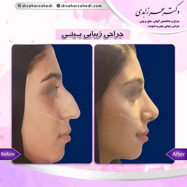 جراحی بینی