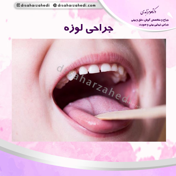 جراحی لوزه