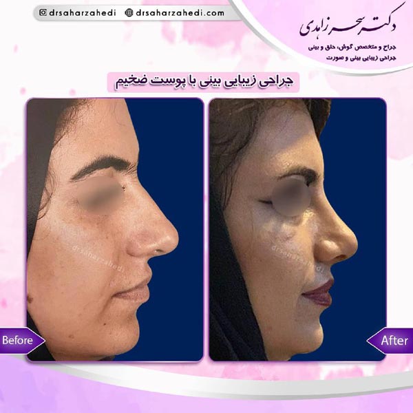 جراحی بینی در تبریز