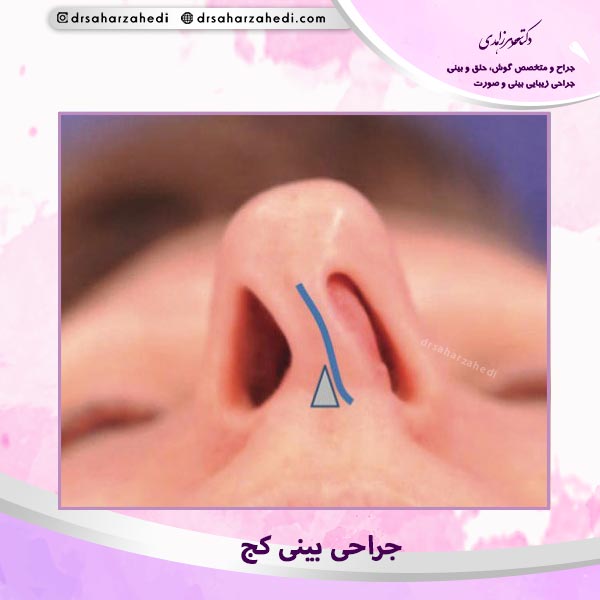 جراحی بینی کج