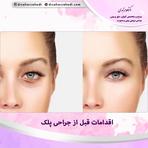 اقدامات قبل از جراحی پلک