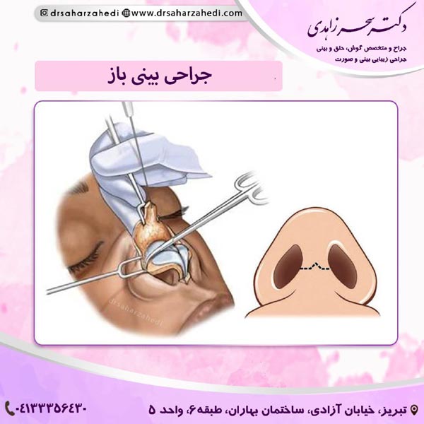جراحی بینی باز