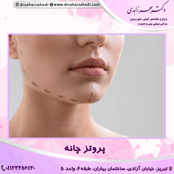 پروتز چانه