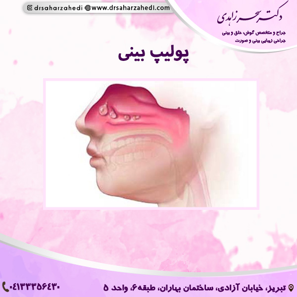 پولیپ بینی