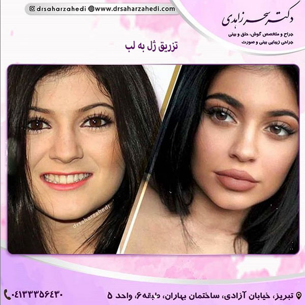 تزریق ژل به لب