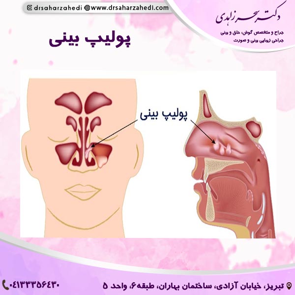 پولیپ بینی - دکتر سحر زاهدی