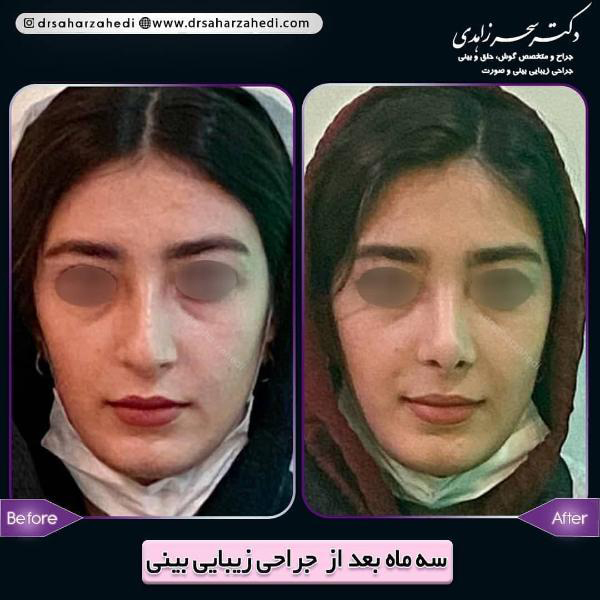 جراحی بینی - دکتر زاهدی
