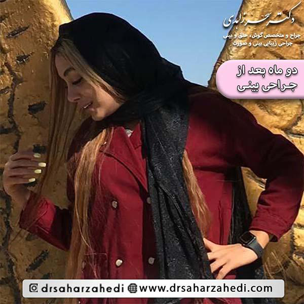 جراحی بینی - سحر زاهدی