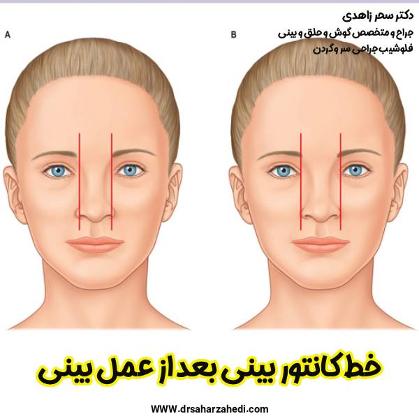 خط کانتور بینی بعد از عمل بینی - دکتر سحر زاهدی
