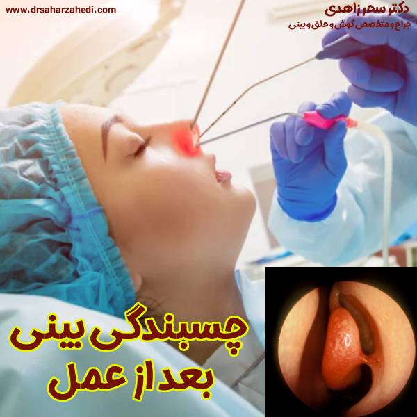 چسبندگی بینی بعد عمل - دکتر سحر زاهدی