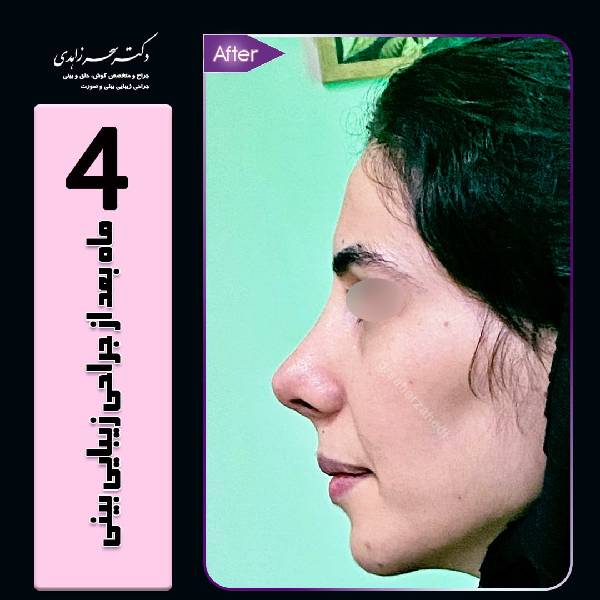 جراحی بینی استخوانی - دکتر سحر زاهدی