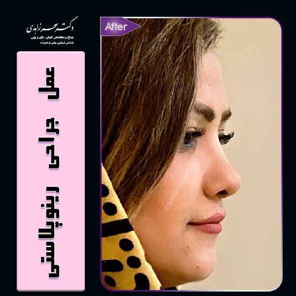 جراحی بینی استخوانی - دکتر سحر زاهدی